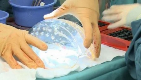 Trasplante de cráneo: una joven recibió prótesis impresa en 3D